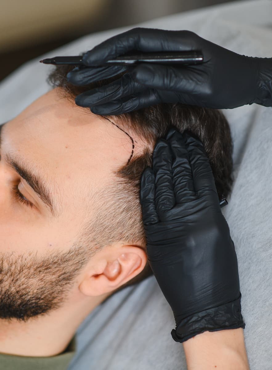 Marcación de la línea frontal previa a un injerto capilar