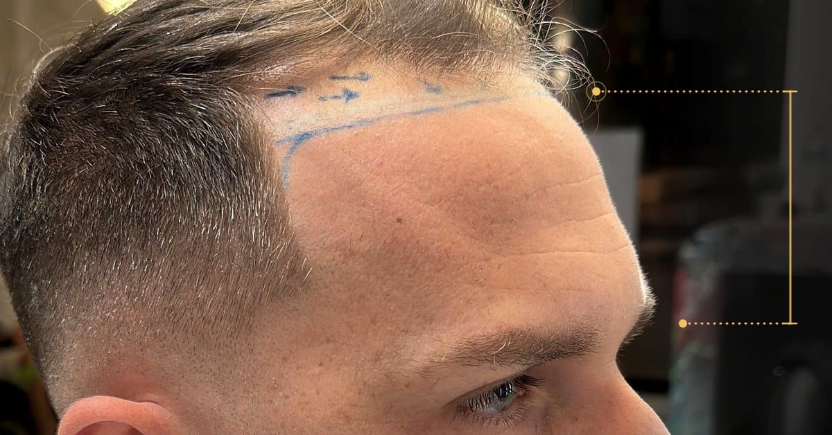 Diseño de la línea frontal marcado sobre la frente de un paciente durante la planificación