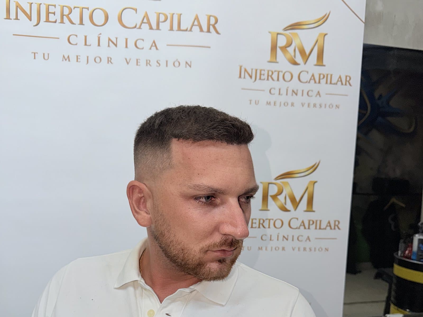 Paciente de perfil en la clínica de RM Injerto Capilar en Tomares