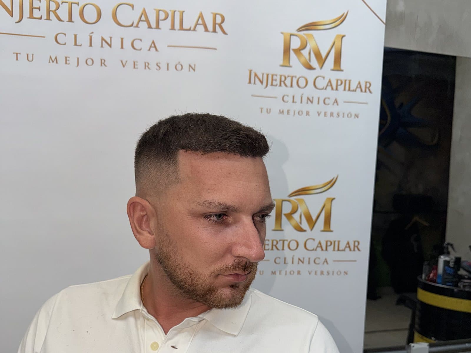 Paciente de perfil en la clínica de RM Injerto Capilar