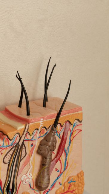 ¿Cuántos Injertos Capilares Necesitas? Grados de Alopecia y Cálculo Real