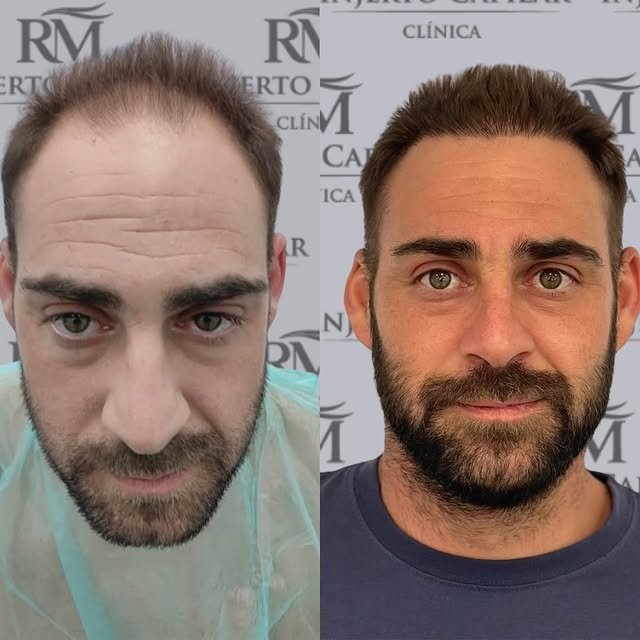Caso real de densidad capilar recuperada, antes y después — RM Injerto Capilar