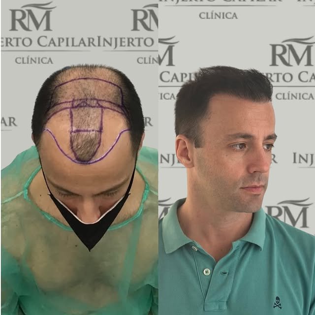 Caso real de injerto capilar FUE GOLD, antes y después — RM Injerto Capilar Sevilla