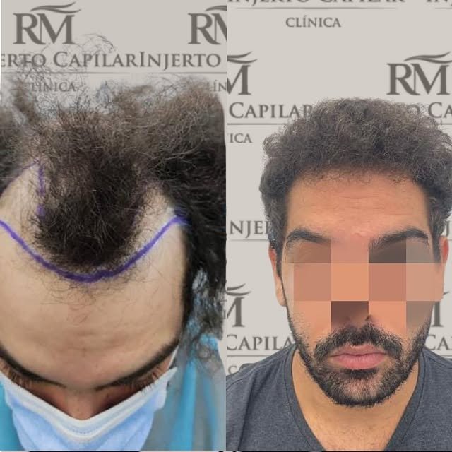 Caso real de injerto capilar FUE GOLD, antes y después — RM Injerto Capilar
