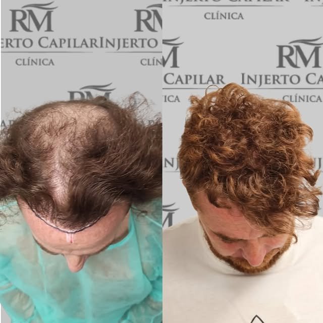Caso real de injerto capilar, resultado natural — RM Injerto Capilar Sevilla