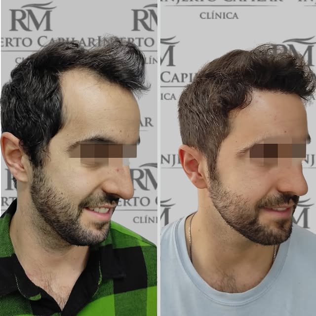 Caso real de trasplante capilar FUE, antes y después — RM Injerto Capilar