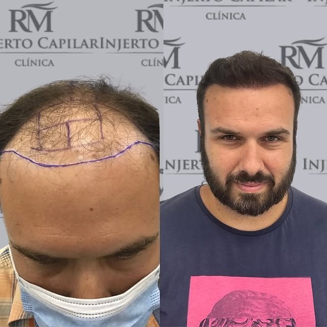 Caso real de injerto capilar sin rapar, antes y después — RM Injerto Capilar
