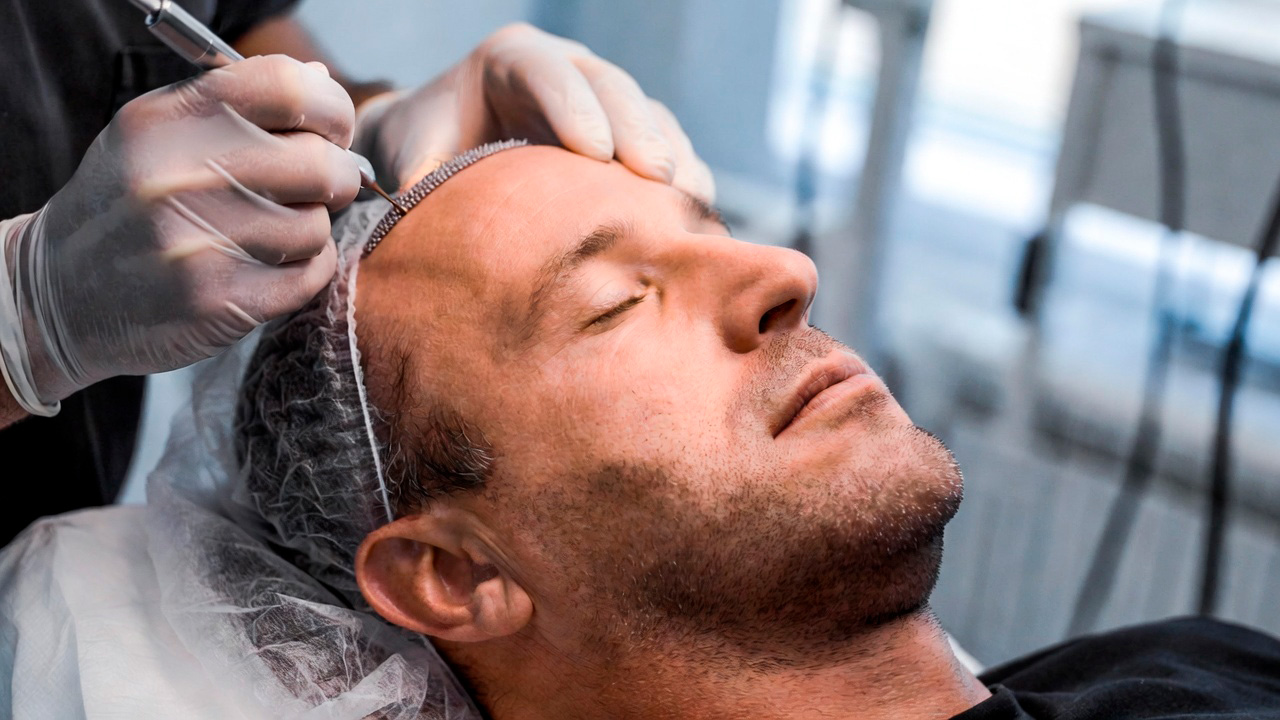 Caballero recibiendo un injerto capilar masculino en la clínica RM Injerto capilar.
